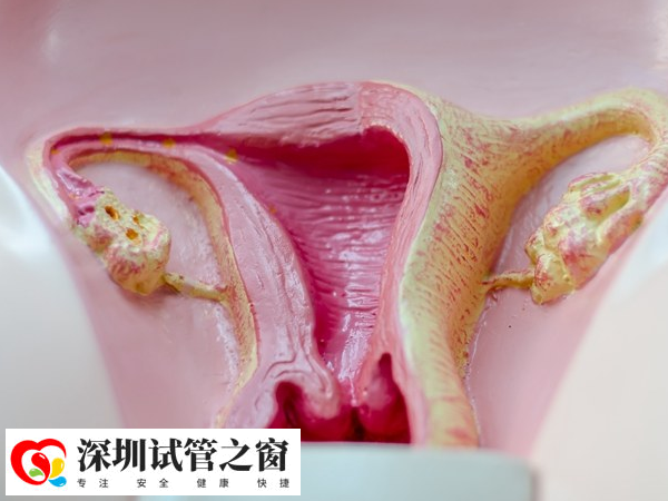 取卵可能会引起卵巢扭转